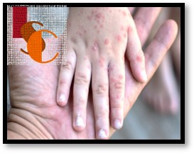 En Campeche, más de 200 menores contrajeron Coxsackie este 2025. 